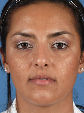 Before Image: Primary Rhinoplasty - front