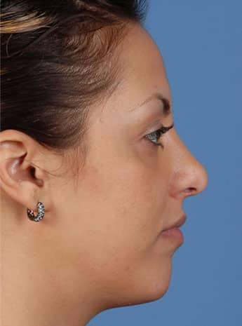 After Image: Primary Rhinoplasty - right-side