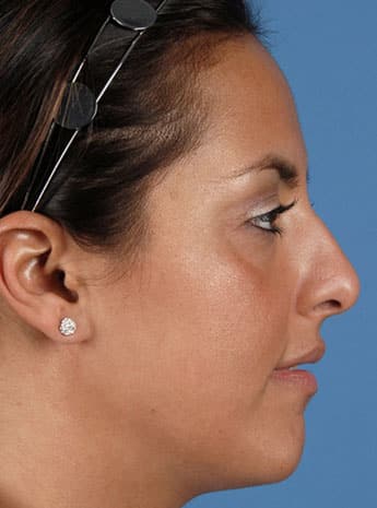 Before Image: Primary Rhinoplasty - right-side