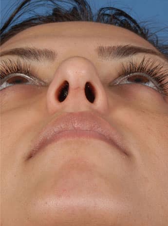 After Image: Primary Rhinoplasty - front