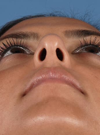 Before Image: Primary Rhinoplasty - front