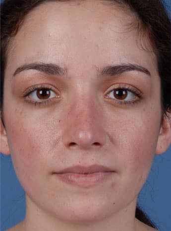 After Image: Primary Rhinoplasty - front