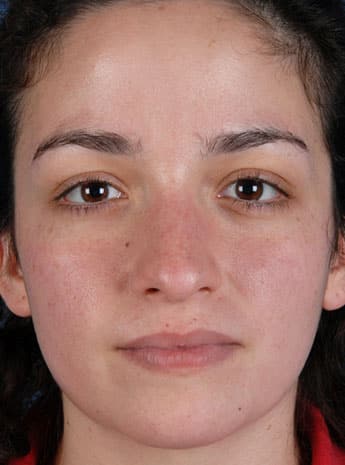 Before Image: Primary Rhinoplasty - front