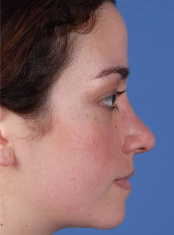 After Image: Primary Rhinoplasty - right-side