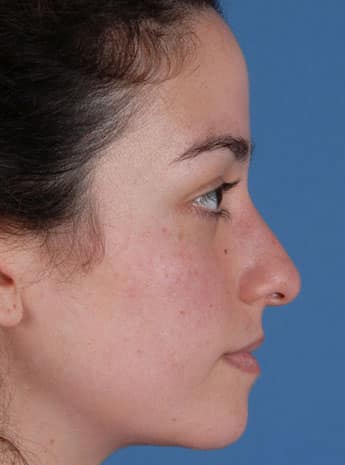 Before Image: Primary Rhinoplasty - right-side