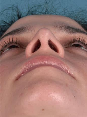 After Image: Primary Rhinoplasty - front