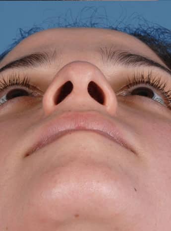 Before Image: Primary Rhinoplasty - front