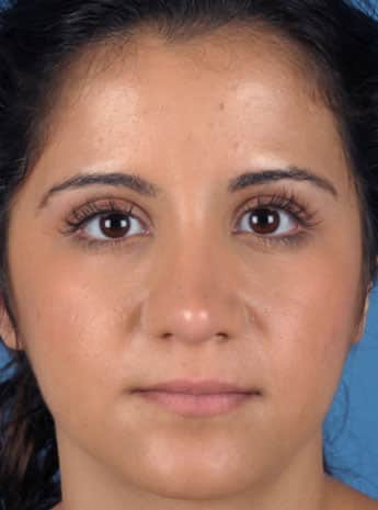 After Image: Primary Rhinoplasty - front