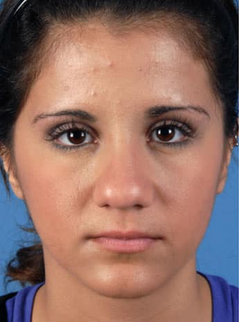 Before Image: Primary Rhinoplasty - front