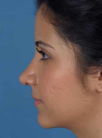 After Image: Primary Rhinoplasty - left-side