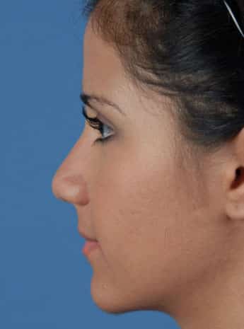 Before Image: Primary Rhinoplasty - left-side