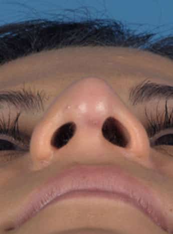 After Image: Primary Rhinoplasty - front