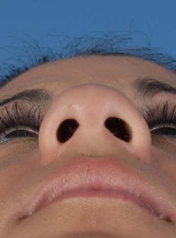 Before Image: Primary Rhinoplasty - front