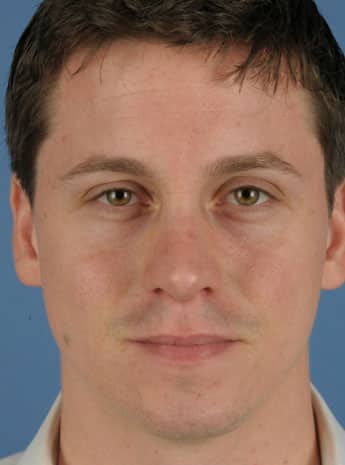 After Image: Primary Rhinoplasty - front