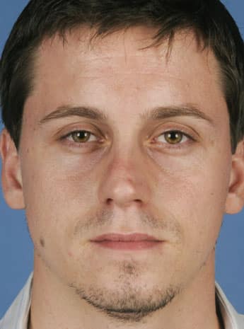 Before Image: Primary Rhinoplasty - front