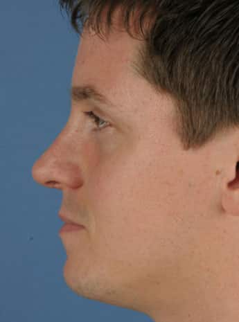 After Image: Primary Rhinoplasty -