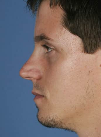 Before Image: Primary Rhinoplasty -