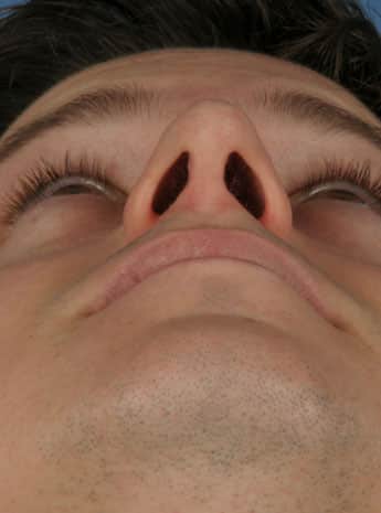 After Image: Primary Rhinoplasty - front