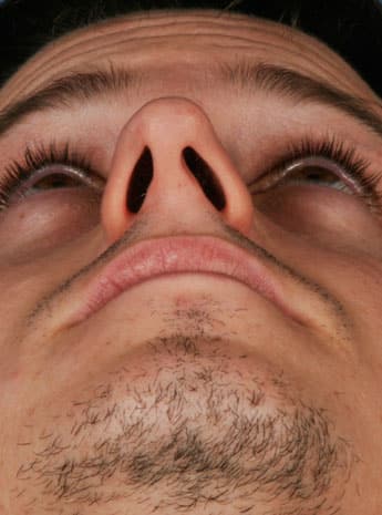 Before Image: Primary Rhinoplasty - front