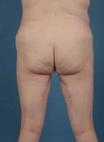 After Image: Inner Thigh Lift - back