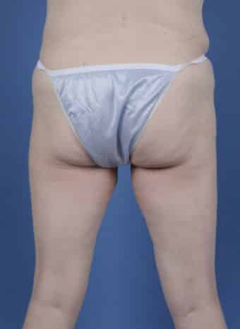 Before Image: Inner Thigh Lift - back