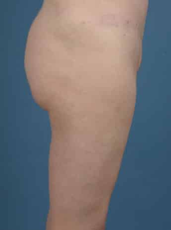 After Image: Inner Thigh Lift - right-side