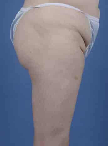 Before Image: Inner Thigh Lift - right-side