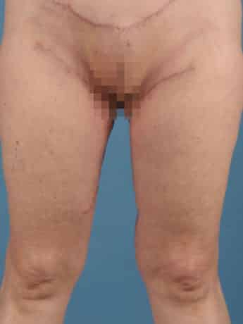 After Image: Inner Thigh Lift - front