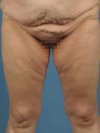 Before Image: Inner Thigh Lift - front