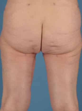 After Image: Inner Thigh Lift - back