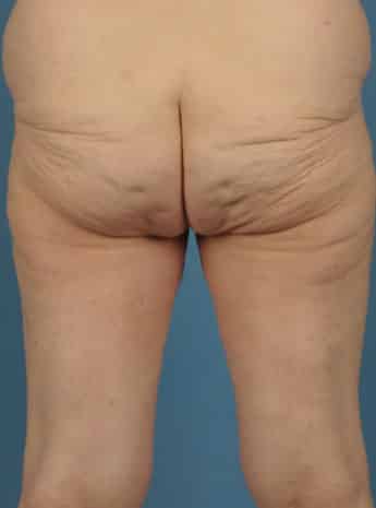 Before Image: Inner Thigh Lift - back