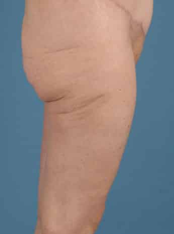 After Image: Inner Thigh Lift - right-side