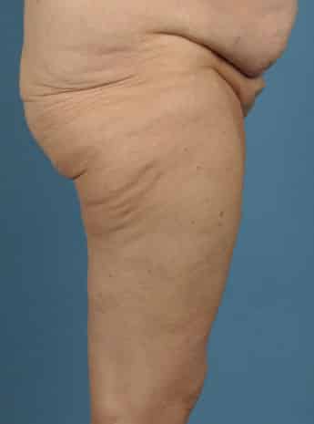 Before Image: Inner Thigh Lift - right-side