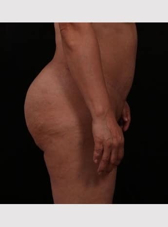 After Image: Tummy Tuck (Abdominoplasty) - other