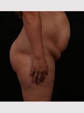 Before Image: Tummy Tuck (Abdominoplasty) - other