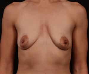 Before Image: Breast Augmentation