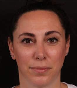 Rhinoplasty