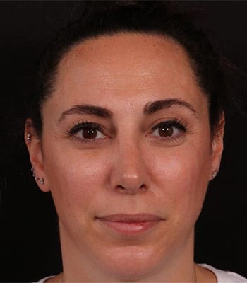 After Image: Rhinoplasty - front