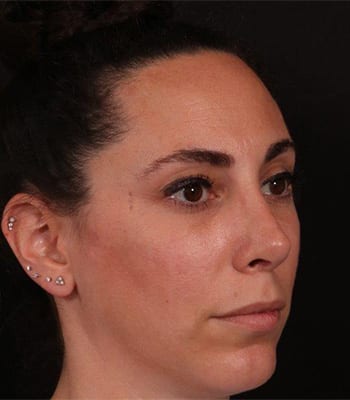After Image: Rhinoplasty - right-front-oblique