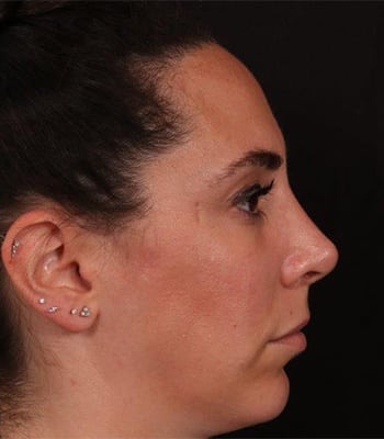 After Image: Rhinoplasty - right-side