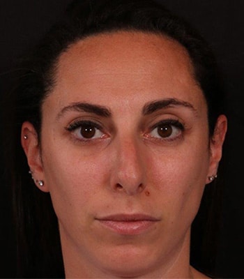 Before Image: Rhinoplasty - front