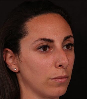 Before Image: Rhinoplasty - right-front-oblique