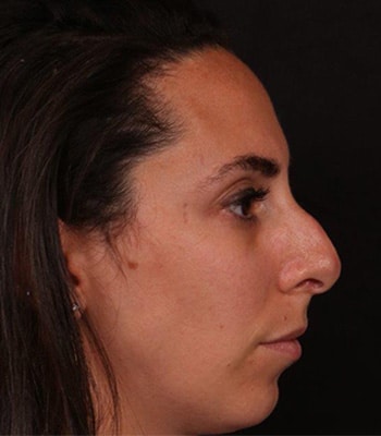 Before Image: Rhinoplasty - right-side