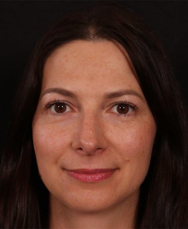 After Image: Rhinoplasty - front
