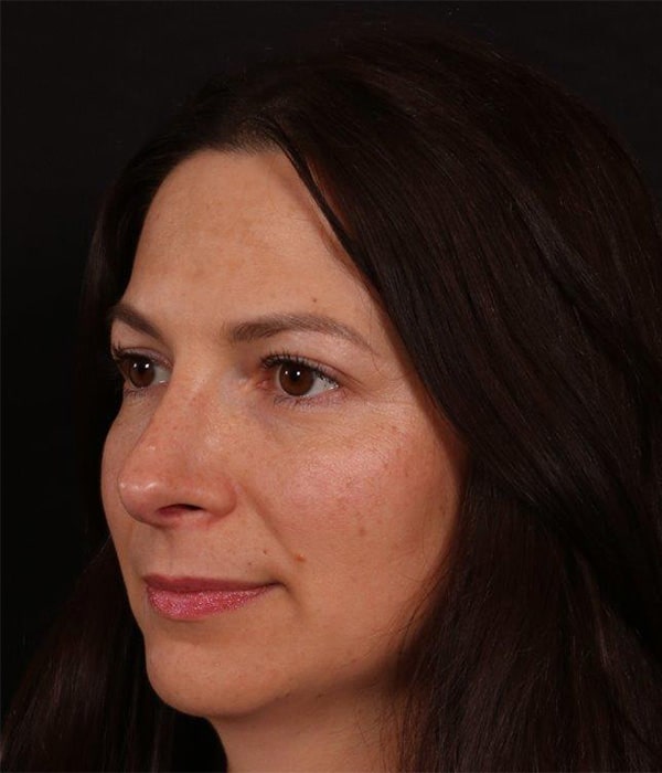 After Image: Rhinoplasty - left-front-oblique