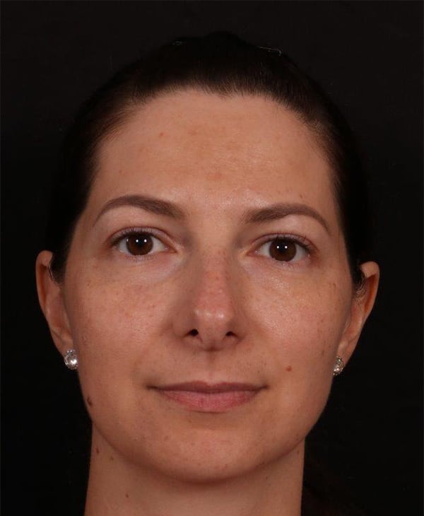 Before Image: Rhinoplasty - front