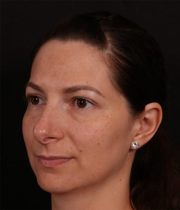 Before Image: Rhinoplasty - left-front-oblique