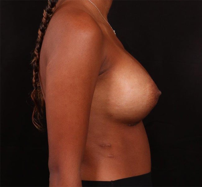 After Image: Breast Augmentation - right-side