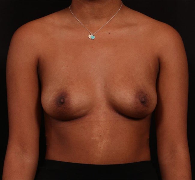 Before Image: Breast Augmentation - front