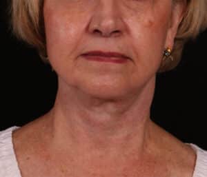 After Image: Facelift